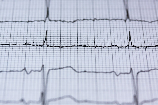 NEZDRAV NAČIN ŽIVOTA  Povećan broj srčanih udara kod mlađih osoba